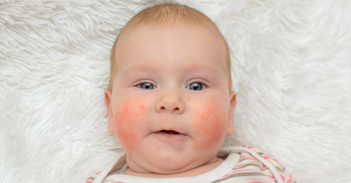 Rash shop from teething
