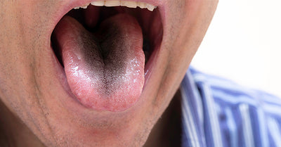 BLACK HAIRY TONGUE CAUSES, SYMPTOMS, AND TREATMENTS