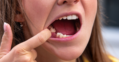 HOW TO AVOID TOOTH LOSS - Dr. Lara Coseo