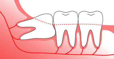 EVERYTHING YOU NEED TO KNOW ABOUT WISDOM TEETH - Dr. Samuel