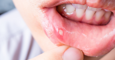 CANKER SORES - Dr. Lara Coseo