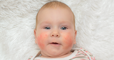 TEETHING RASH - Ruby Baig