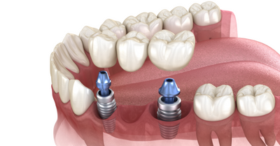 DENTAL IMPLANTS: TYPES AND HOW TO - Dr. Nosheen