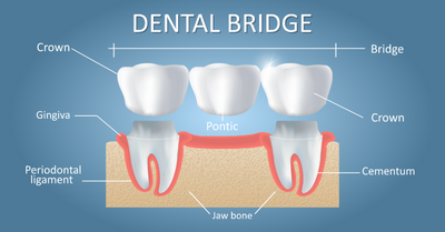 DENTAL BRIDGES: WHAT YOU NEED TO KNOW - Dr. Millie