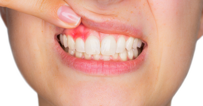 GINGIVITIS: CAUSES, SYMPTOMS, TREATMENTS - Dr. Jigisha