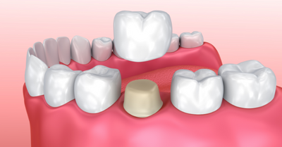 DENTAL CROWNS - Dr. Arif Khan