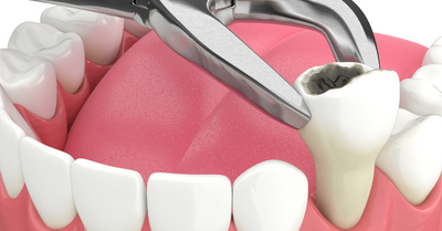 TOOTH EXTRACTION: PROCEDURE, HEALING, COMPLICATIONS