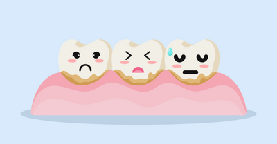 DENTAL TARTAR: CAUSES, PREVENTION, REMOVAL - Dr. Samuel