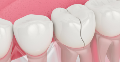 Is An Implant The Only Solution For Cracked & Split Teeth?
