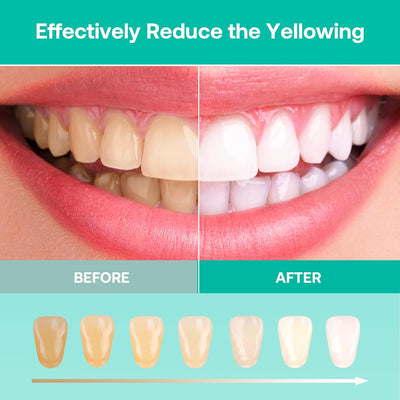 Fairywill Super Whitening Kit for Sensitive Teeth,10Mins Fast Whitening with LED Accelerator light, 4*3ml Whitening Gel and 2*3ml Anti-Sensitive Gel, Safe and Fast and Gentle Teeth Whitening