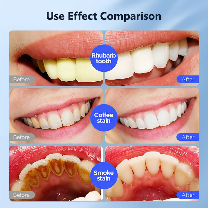 Fairywill Teeth Whitening Kit,24 Blue LED Light with 6*3ml 22% Carbamide Peroxide Teeth Whiten Gel, Built-in timer Gentle and Non-irritating Whiter, Suitable for Beginners or Sensitive Teeth